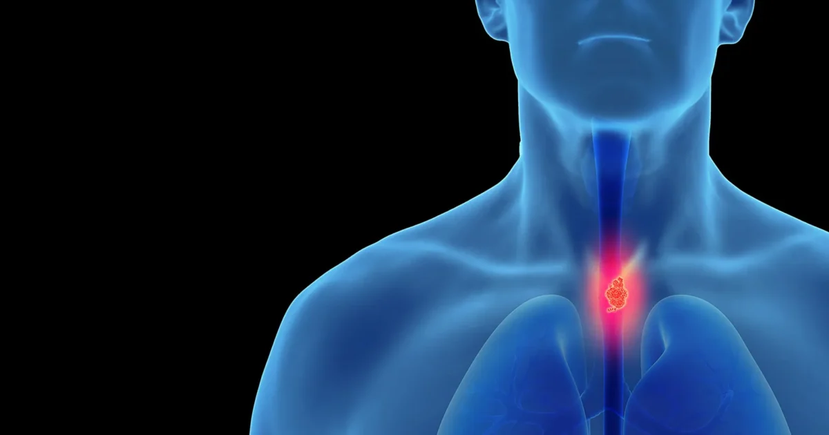 Esophageal Cancer: The Silent Killer