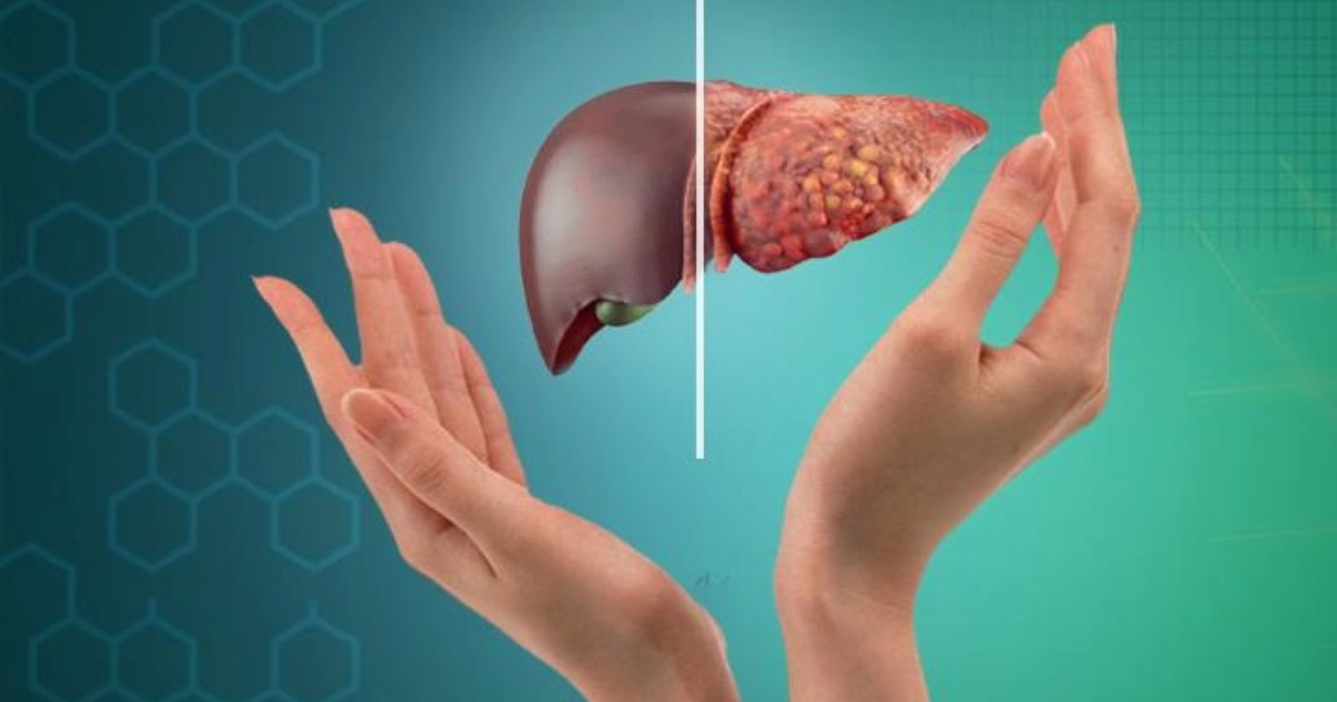 Fatty Liver: 3 Common Myths Debunked