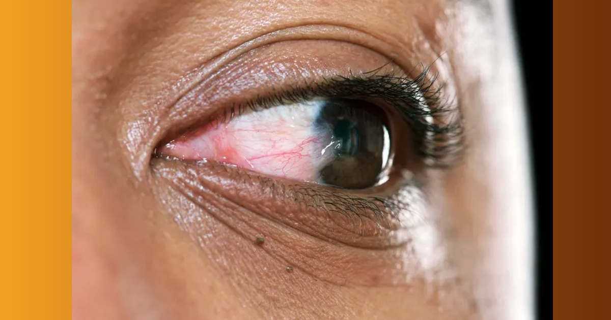 Eyes will tell your health; Watch out for these symptoms to identify cholesterol and diabetes