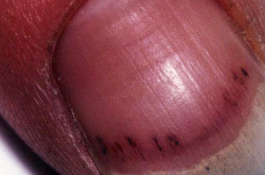  നഖത്തിലെ കറുത്ത വരകൾ അപായലക്ഷണമോ? ഈ മാറ്റങ്ങൾ അവഗണിക്കരുത്