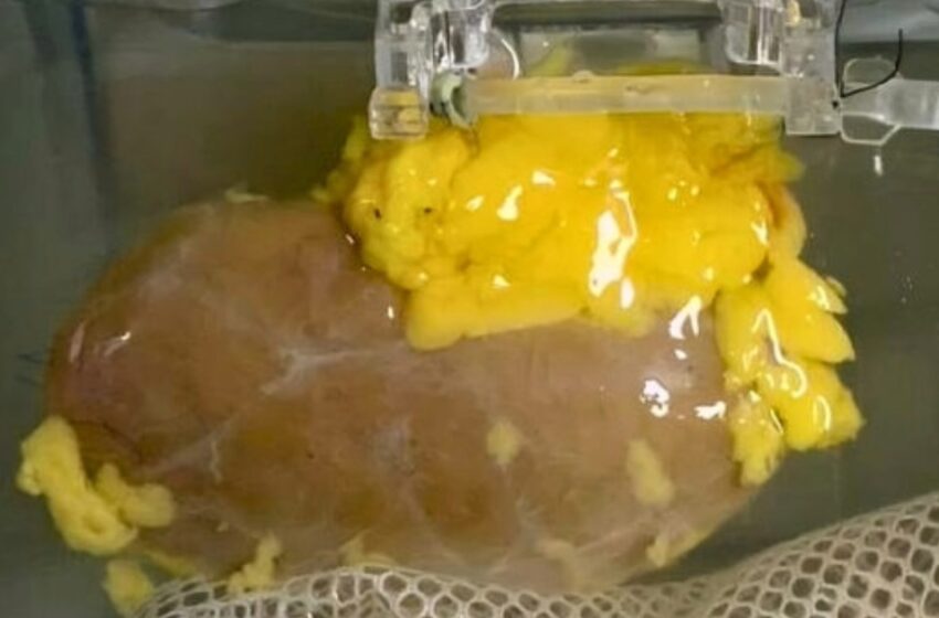  രക്തഗ്രൂപ്പ് ഇനി തടസ്സമല്ല; ‘യൂണിവേഴ്‌സൽ’ വൃക്കയുമായി ശാസ്ത്രലോകം, അവയവമാറ്റത്തിൽ വിപ്ലവം