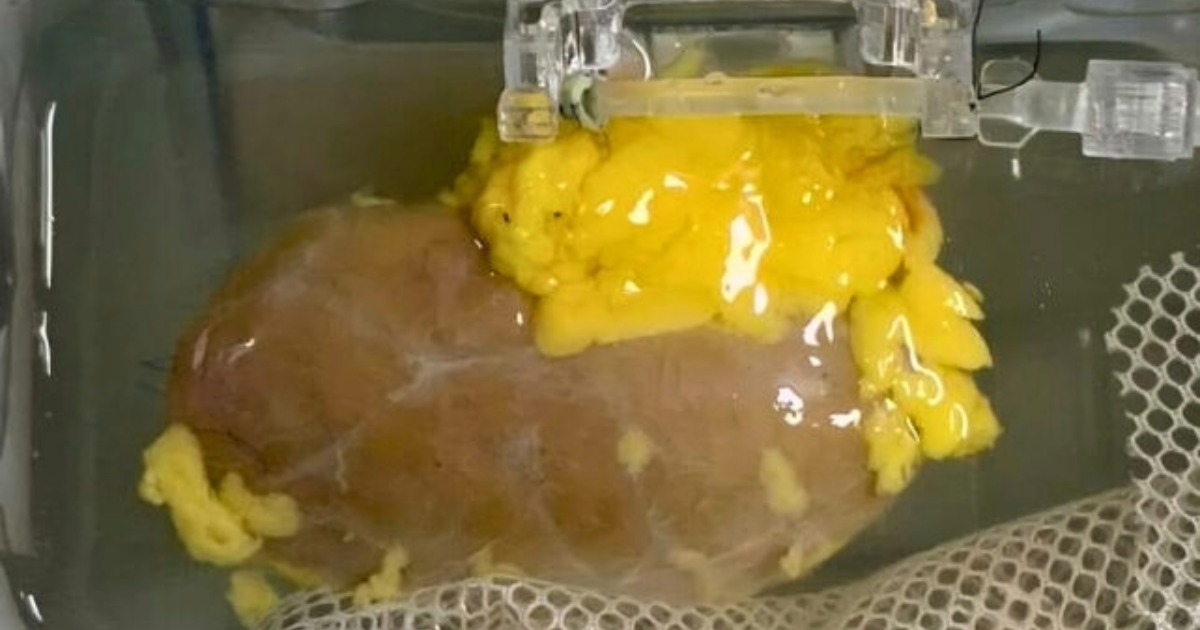 രക്തഗ്രൂപ്പ് ഇനി തടസ്സമല്ല; 'യൂണിവേഴ്‌സൽ' വൃക്കയുമായി ശാസ്ത്രലോകം, അവയവമാറ്റത്തിൽ വിപ്ലവം