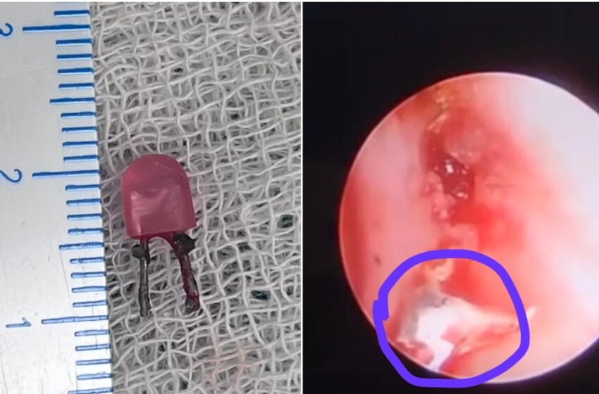  ന്യുമോണിയയല്ല, ശ്വാസകോശത്തിൽ എൽഇഡി ബൾബ്! ഒരു വയസ്സുകാരന്റെ എക്‌സ്‌റേ കണ്ട് ഞെട്ടി ഡോക്ടർമാർ