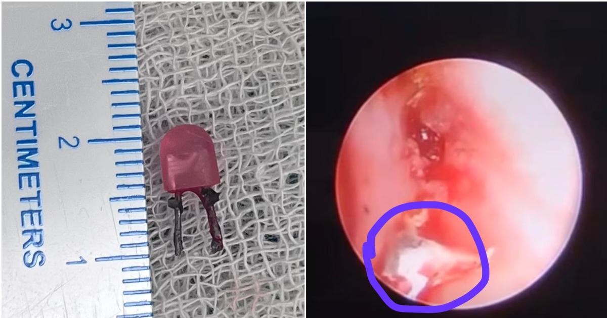 ന്യുമോണിയയല്ല, ശ്വാസകോശത്തിൽ എൽഇഡി ബൾബ്! ഒരു വയസ്സുകാരന് പുനർജന്മം നൽകി ഡോക്ടർമാർLED Bulb in Lung! Doctors Give a Second Life to One-Year-Old