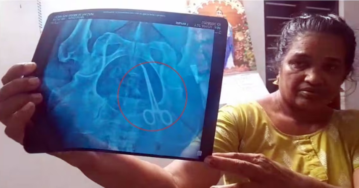 വയറ്റിൽ കത്രികയുമായി വീട്ടമ്മയുടെ ദുരിതജീവിതം; ശസ്ത്രക്രിയ നടന്നത് അഞ്ചുവർഷം മുൻപ് വണ്ടാനം മെഡി.കോളേജിൽ