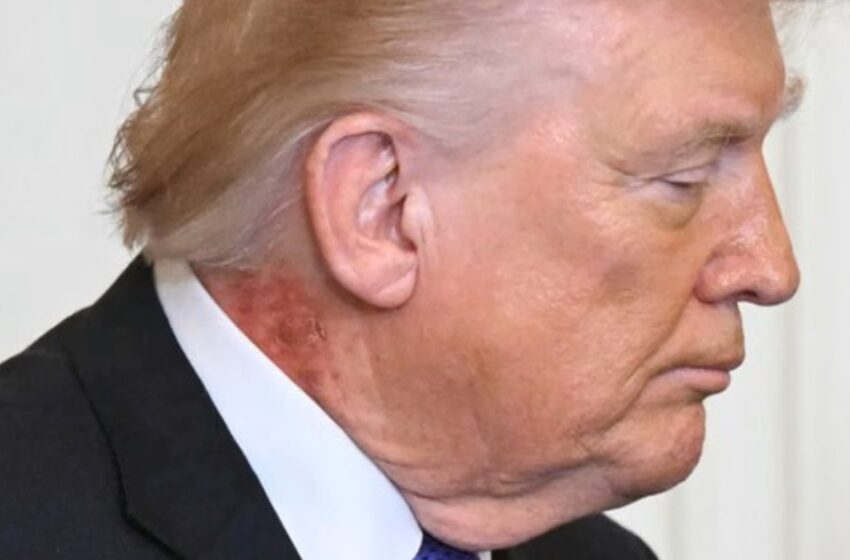  അഭ്യൂഹങ്ങൾക്ക് തുടക്കമിട്ട് ട്രംപിൻ്റെ കഴുത്തിന് പിന്നിലെ പഴുത്ത വ്രണം; സ്കിൻ കെയർ ക്രീം കാരണം ഉണ്ടായ പരിക്കെന്ന് വൈറ്റ് ഹൗസ്