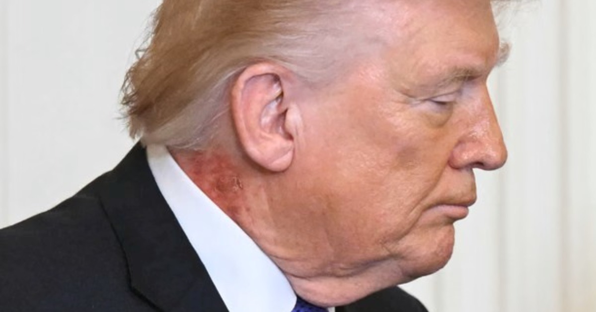 അഭ്യൂഹങ്ങൾക്ക് തുടക്കമിട്ട് ട്രംപിൻ്റെ കഴുത്തിന് പിന്നിലെ പഴുത്ത വ്രണം; സ്കിൻ കെയർ ക്രീം കാരണം ഉണ്ടായ പരിക്കെന്ന് വൈറ്റ് ഹൗസ് Trump’s Neck Rash: White House Cites 'Preventative' Skin Treatment