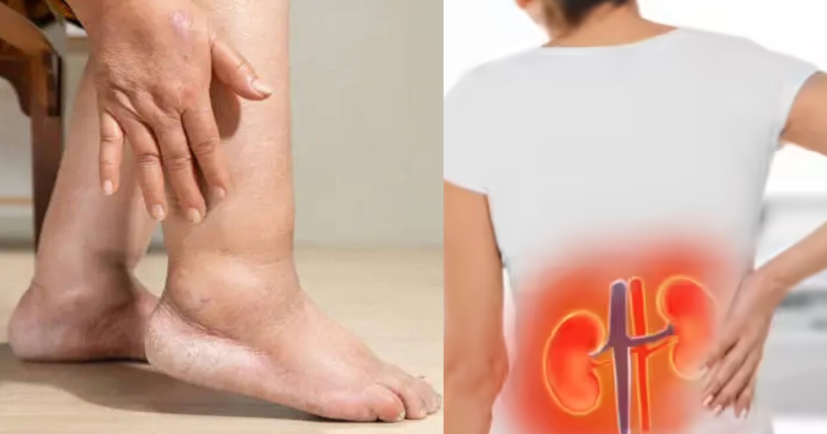  കണങ്കാലിലെ വീക്കം നിസാരമാക്കരുത്; വൃക്ക തകരാറിലാണെന്ന് സൂചിപ്പിക്കുന്ന 5 ലക്ഷണങ്ങൾ അറിയാം