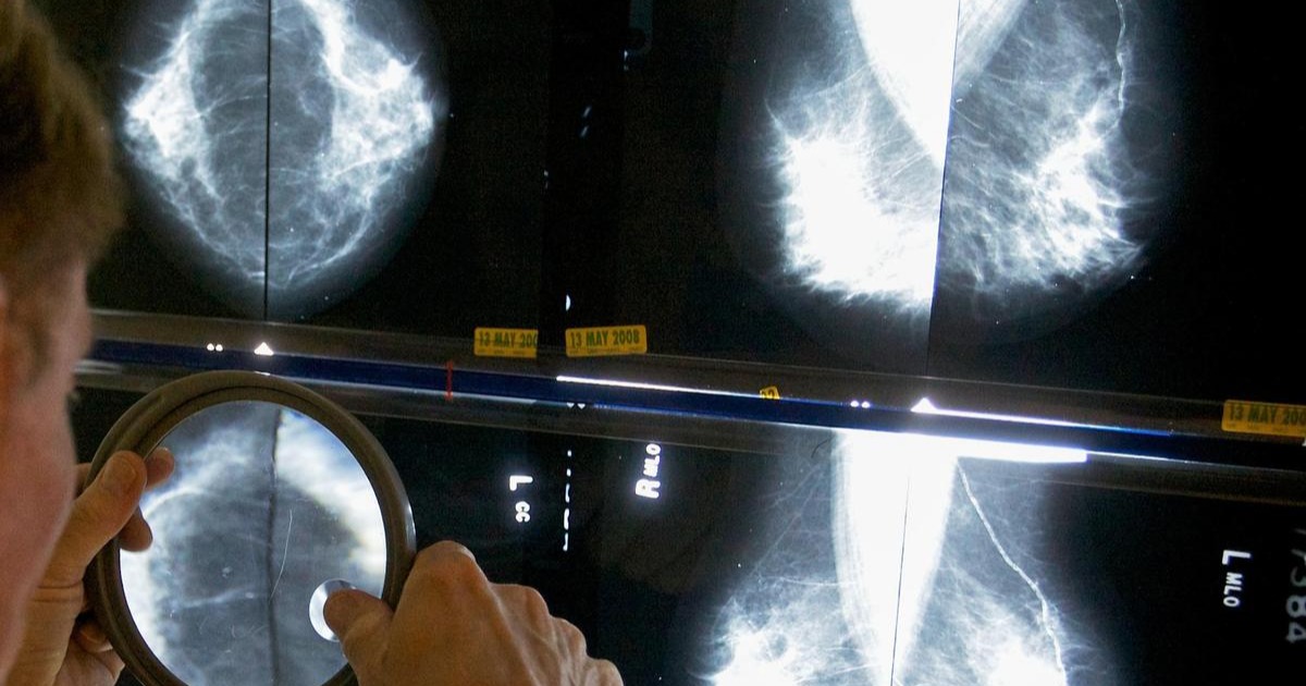  30 വർഷം, ഇരട്ടിയിലധികം കേസുകൾ: ഇന്ത്യയിൽ സ്തനാർബുദം പടരുന്നു