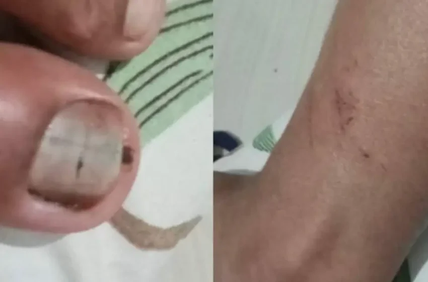 വാച്ച് മോഷ്ടിച്ചെന്ന് ആരോപണം: കണ്ണിലും സ്വകാര്യഭാഗത്തും മുളക് തേച്ചു, നഖത്തിൽ ഈര്‍ക്കില്‍ കയറ്റി; കോഴിക്കോട് 12-കാരനോട് ബന്ധുക്കളുടെ ക്രൂരത