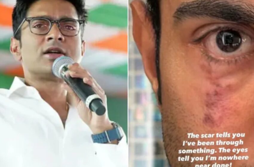  ‘ഈ പാട് ഞാൻ എന്തിലൂടെയാണ് കടന്നുപോയതെന്ന് ഓർമിപ്പിക്കുന്നു’; ആകാംക്ഷയും ആശങ്കയും നിറച്ച് അഭിഷേക് ബാനർജിയുടെ കുറിപ്പ്